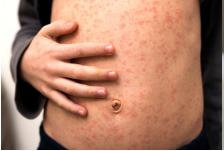 孩子得了水痘怎么办啊,成年人得了水痘痛不欲生