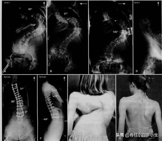 孩子脊柱侧弯怎么治疗,孩子脊柱侧弯最佳治疗方法