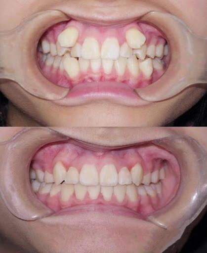 小孩长了虎齿怎么办,小孩长老虎的牙可以矫正吗