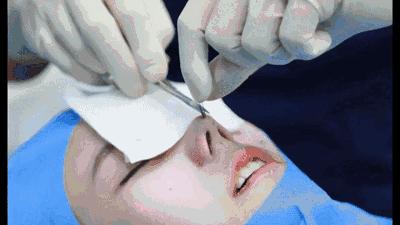 线雕隆鼻能维持几年还是那么挺,线雕隆鼻真的能吸收吗