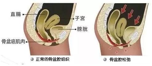 产后骨盆修复有必要吗？如何产后骨盆修复？