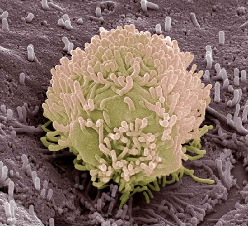 直肠癌保肛手术方案,放射治疗适合哪些直肠癌患者