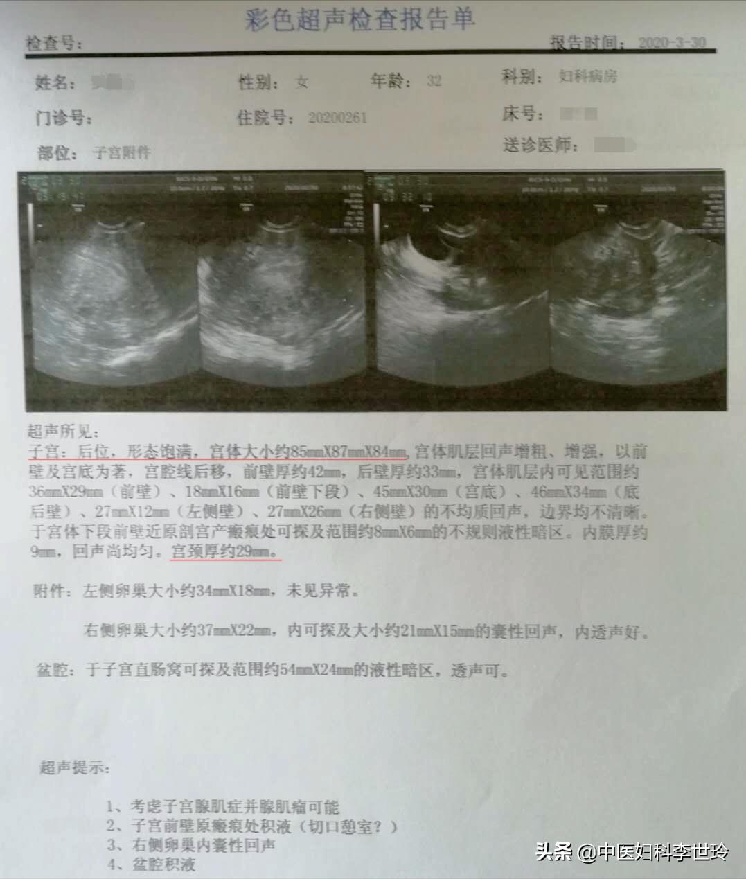 子宫腺肌症中医辨证,温经汤治疗子宫腺肌症