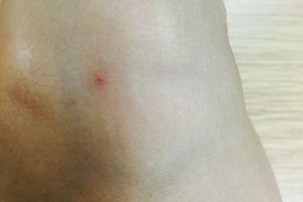 突然长出的红痣是怎么回事,身体上突然长红痣是什么原因