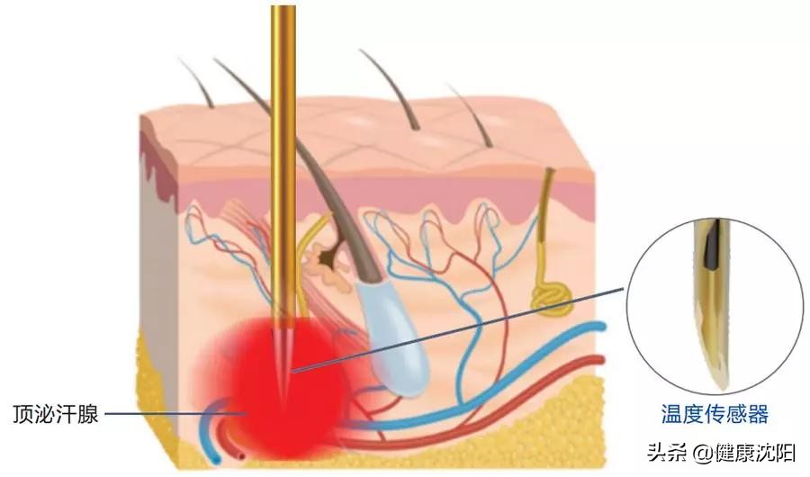 腋臭味道太重怎么掩盖,狐臭净味大讲堂