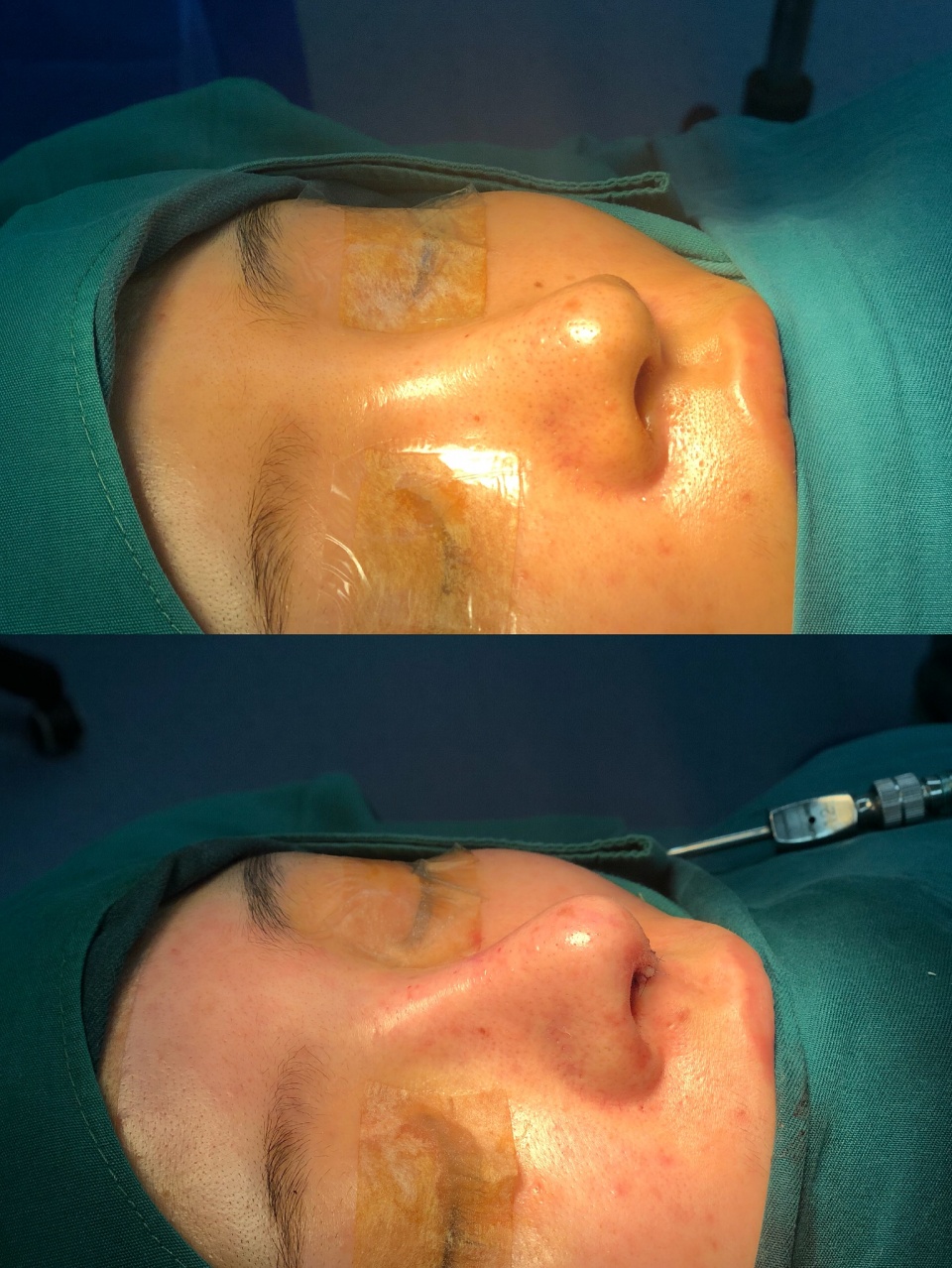 网红鼻子修复效果图,鼻整形多久可以修复