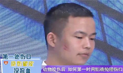 伤口没有出血要消毒吗,被狗咬了没有流血要打狂犬疫苗吗