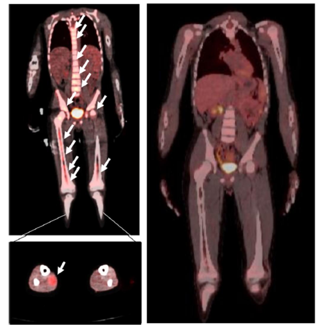 儿童横纹肌肉瘤左髂骨转移,平滑肌肉瘤晚期靶向药