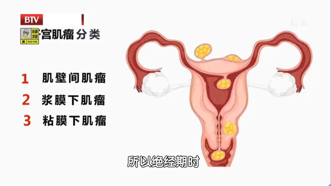 子宫肌瘤是切除好还是保留好,子宫肌瘤建议多少岁要切掉