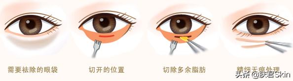 有什么沟必须火的,泪沟后面有一条很深的沟叫什么