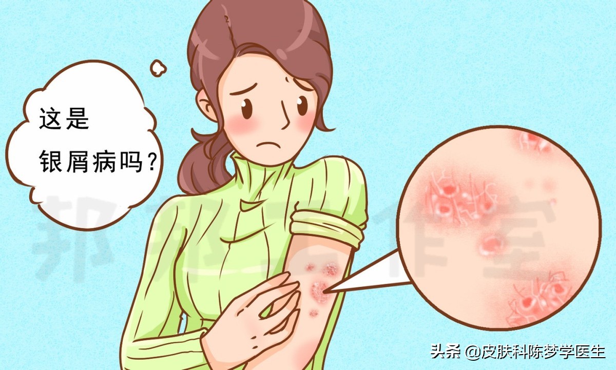 红色斑块脱屑一定是牛皮癣吗,皮肤上有癣起皮颜色呈褐色