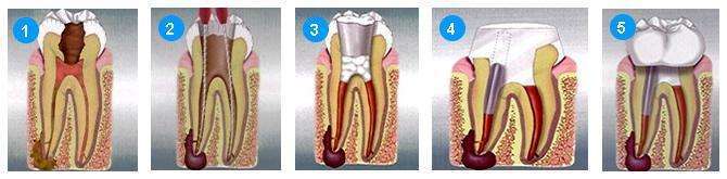 根管治疗后还不敢吃东西怎么办,根管治疗后能直接吃东西吗