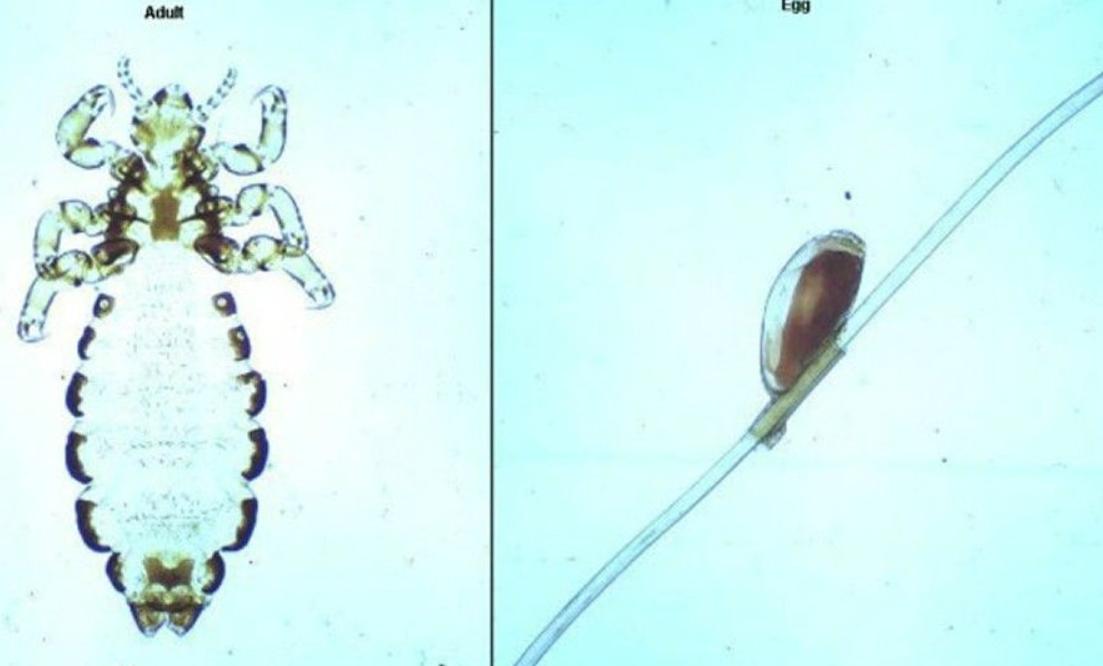 30年前人人身上都有的虱子,30年前人人都有虱子为啥现在消失