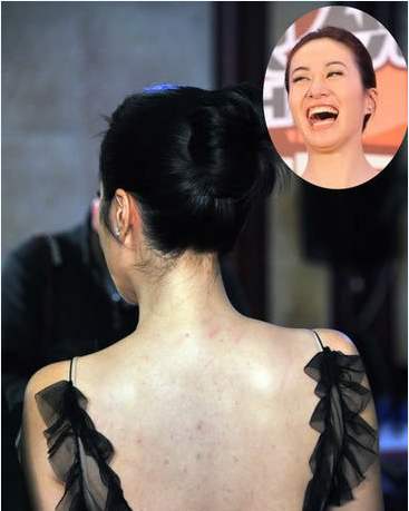 身上的螨虫会粘在衣服上吗,身上螨虫太多身体会烂么