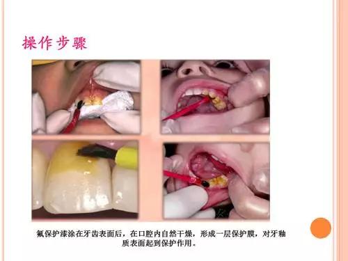 吃什么食物可以预防和修复蛀牙,孩子预防蛀牙新方法也太奇葩了