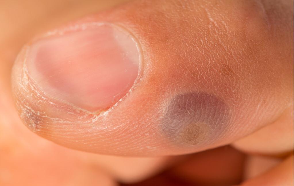 法令纹去除应该填充还是去皱,法令纹除了填充就没其他方法了吗