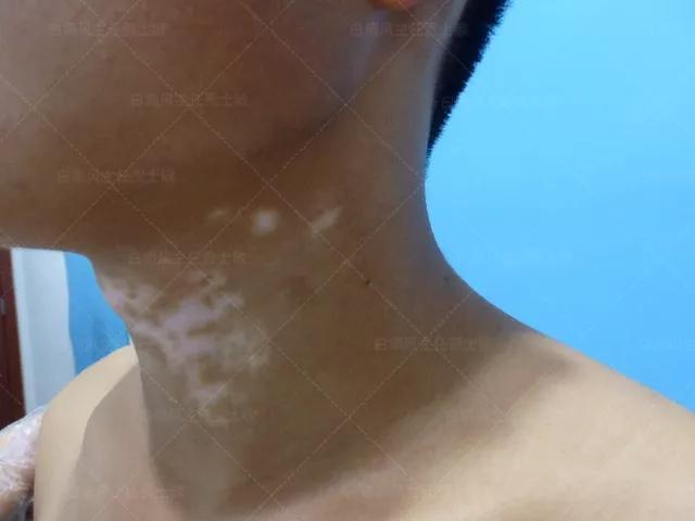 18岁男孩高考备战,18岁男孩白斑