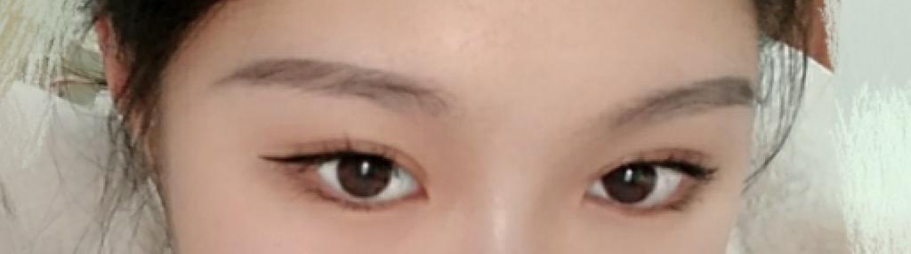 双眼皮手术详细教程,埋线双眼皮手术全过程