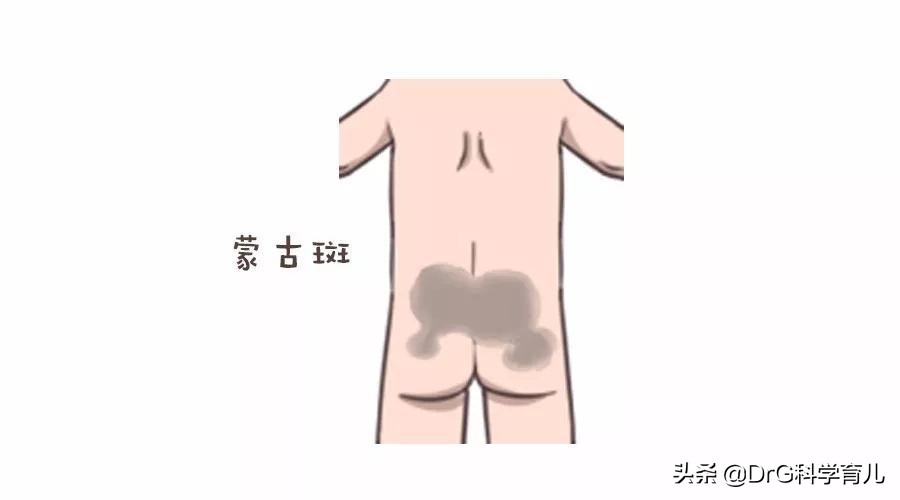 天生胎记黑毛痣会癌变会死吗,脖子上有个黑色胎记会癌变吗