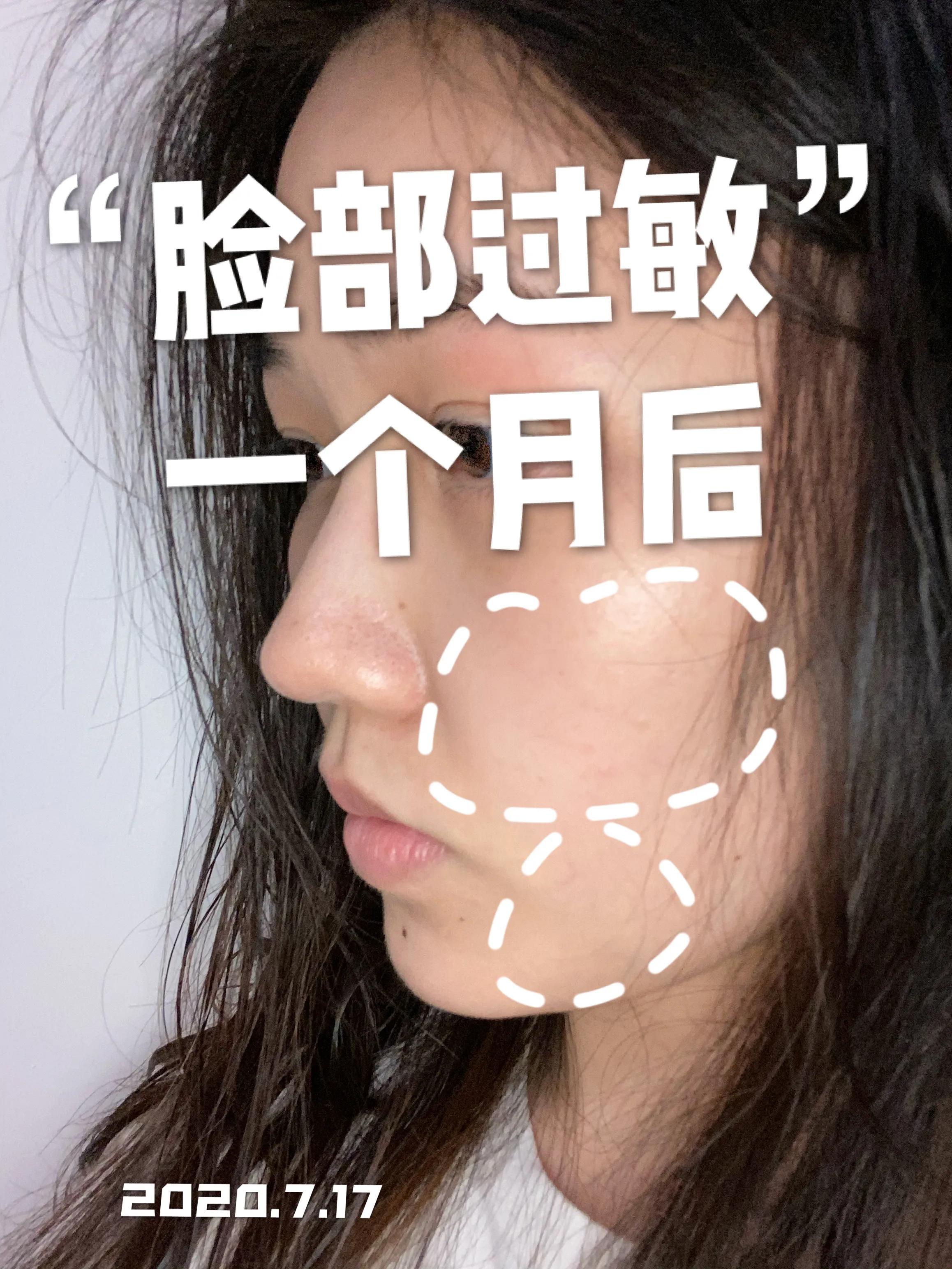 视黄醇过敏烂脸怎么治,烂脸过敏救星