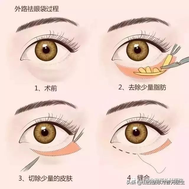 46岁做眼袋还需要做卧蚕吗,现在都把眼袋叫卧蚕了吗