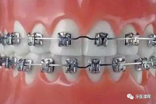 超详细的牙齿矫正过程,成人骨性牙齿矫正过程
