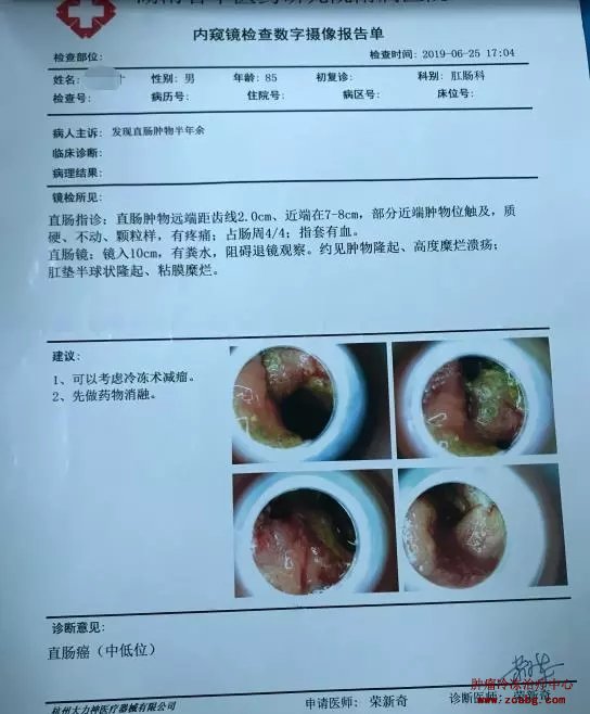 对于低位直肠癌患者，除了改道、放疗、化疗还有其他办法吗
