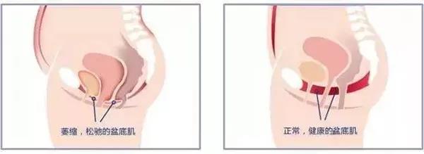 一咳嗽就漏尿警惕产后盆底肌损伤,咳一下就漏尿