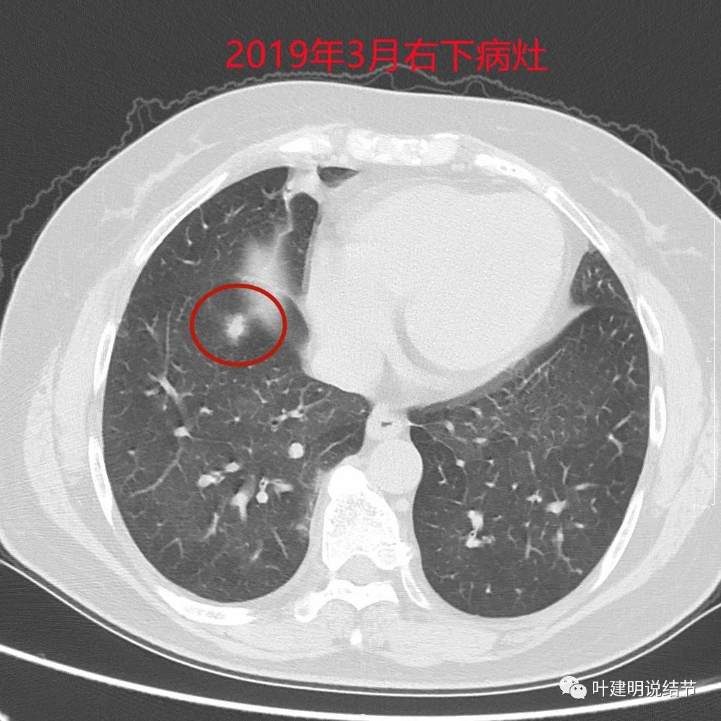 左肺癌手术半年右肺下角还有炎症,左下肺癌晚期