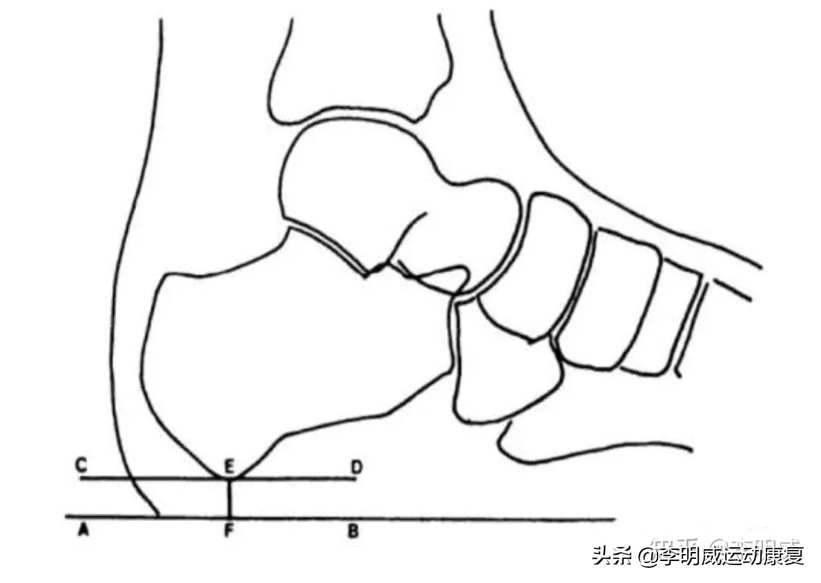 足跟痛做小针刀的危害,足跟痛打封闭针的危害