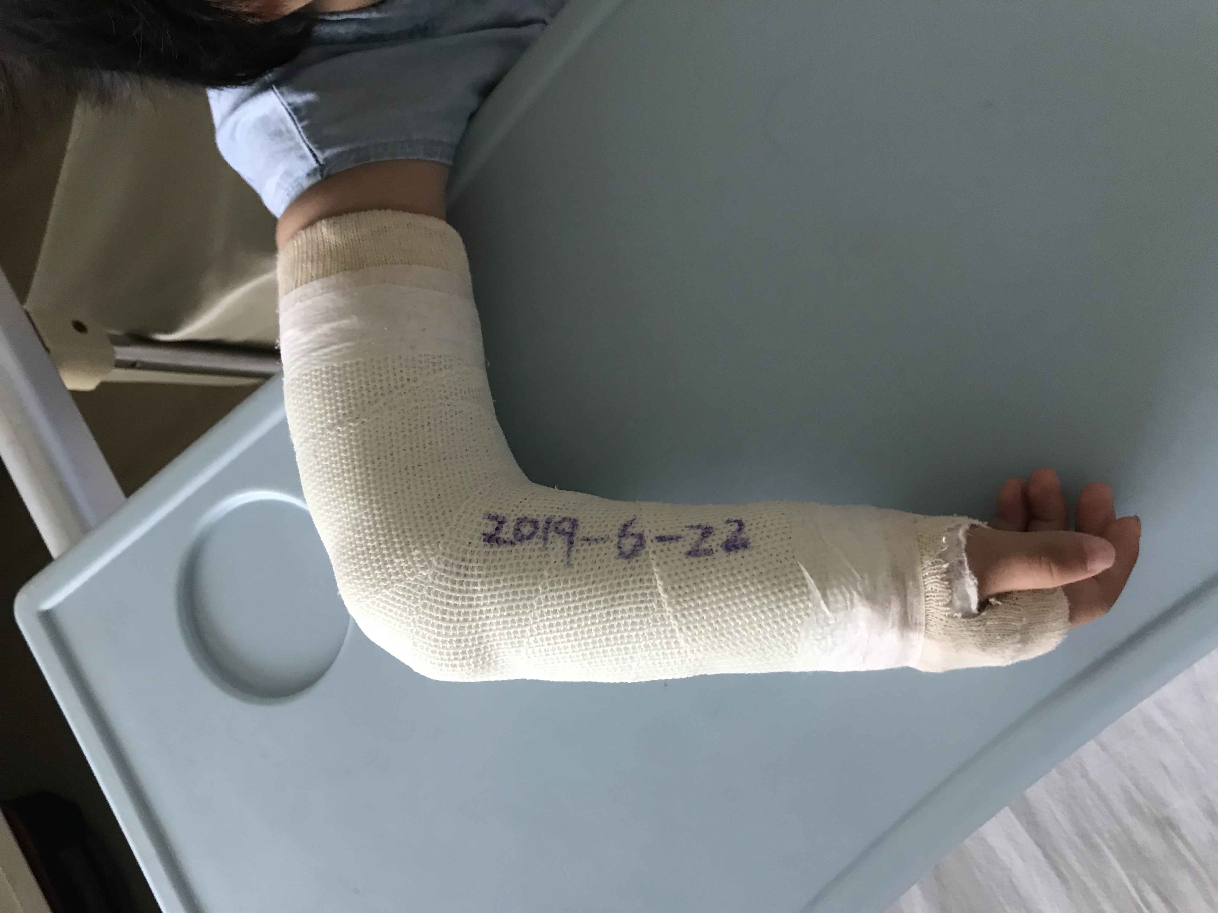 打石膏有什么注意事项,打石膏要注意什么