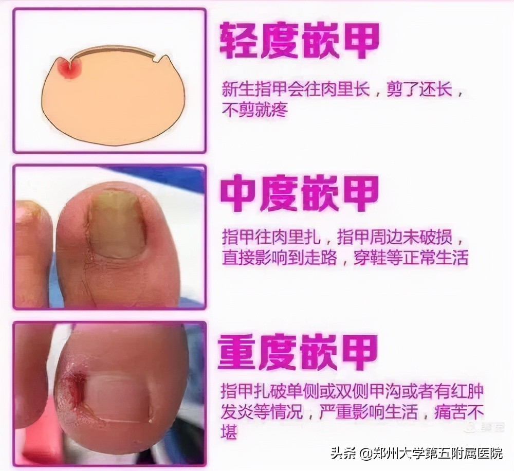 小孩怎么预防嵌甲,怎么预防嵌甲和甲沟炎