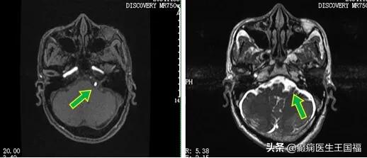 面肌痉挛打肉毒素能根治吗,面肌痉挛打肉毒素可以治愈吗