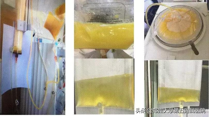 肝病患者血脂高用什么药,临床高胆固醇血症的治疗