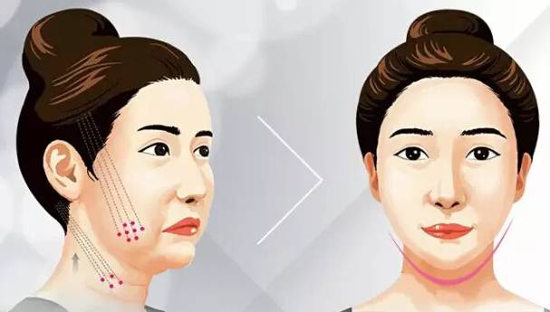 30多岁还能改善下巴后缩吗,30岁还能下颌后缩矫正吗