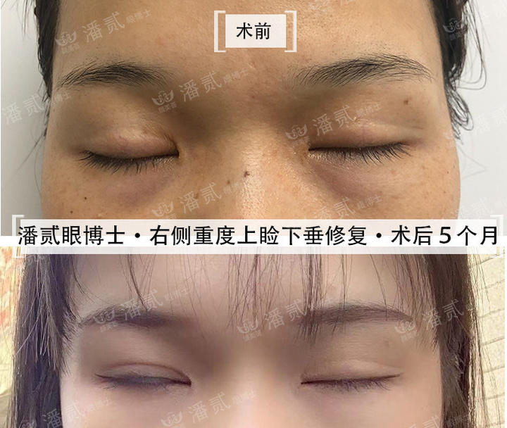 上睑下垂手术是不是永远闭不上眼,做了上睑下垂手术后怎么护理眼睛