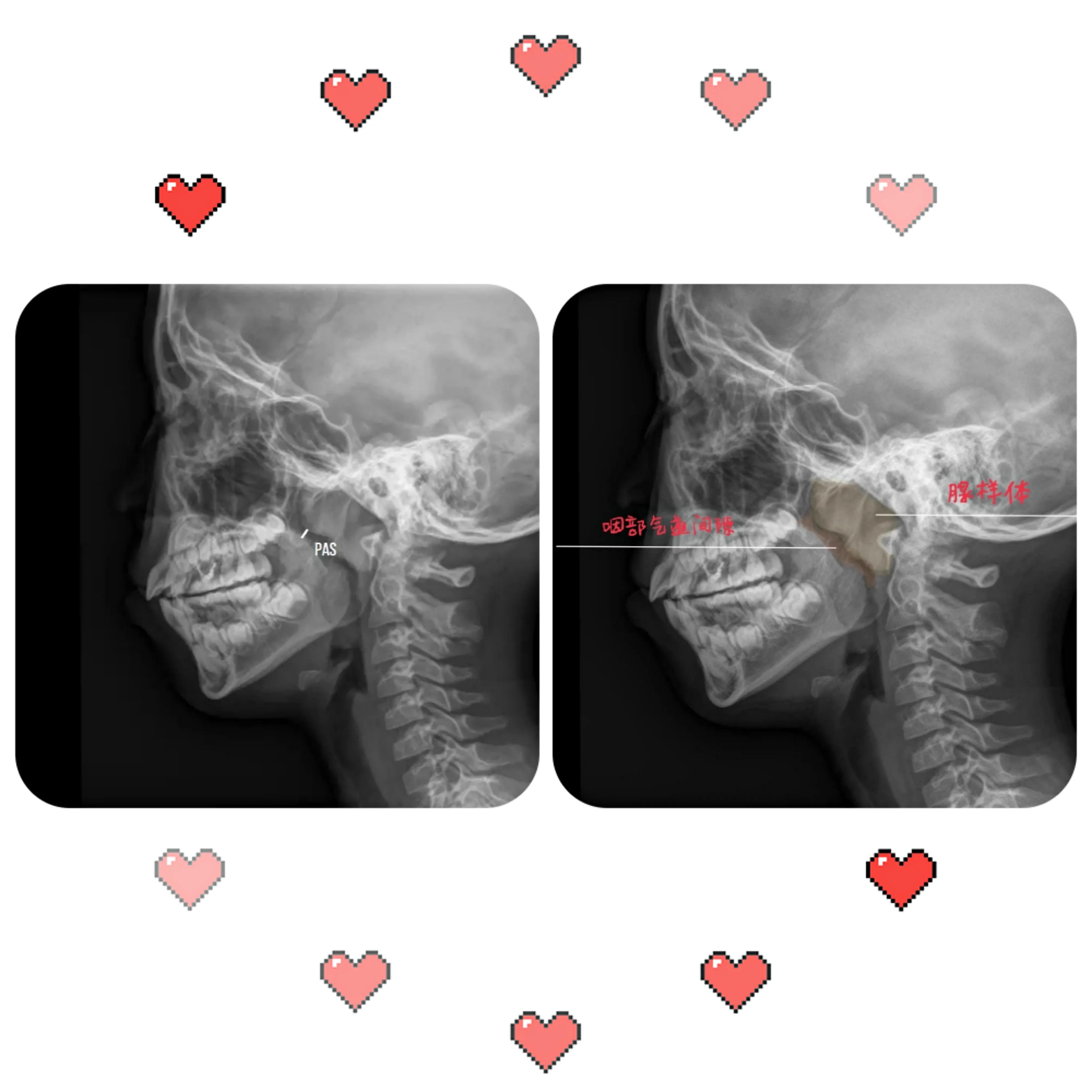 瘦的人睡觉打呼噜是什么原因,十四岁睡觉打呼噜是什么原因