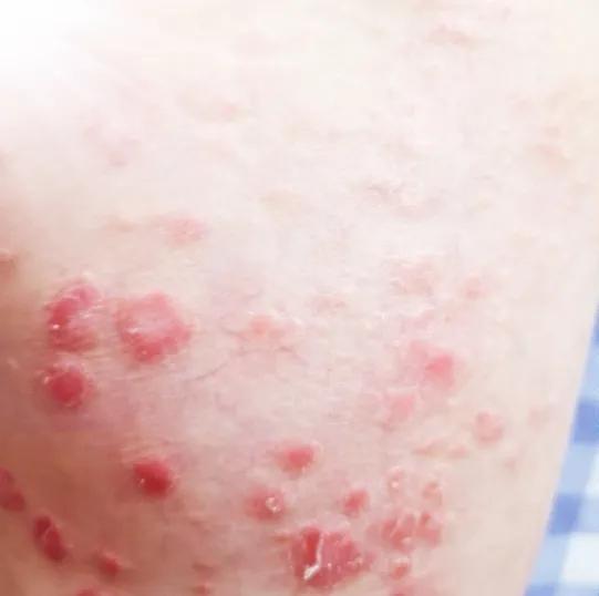 全身长满了牛皮癣属于重度吗,牛皮癣好了突然身上一堆小红疙瘩