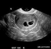 3毫米卵黄囊未见胎芽正常么,40多天的卵黄囊