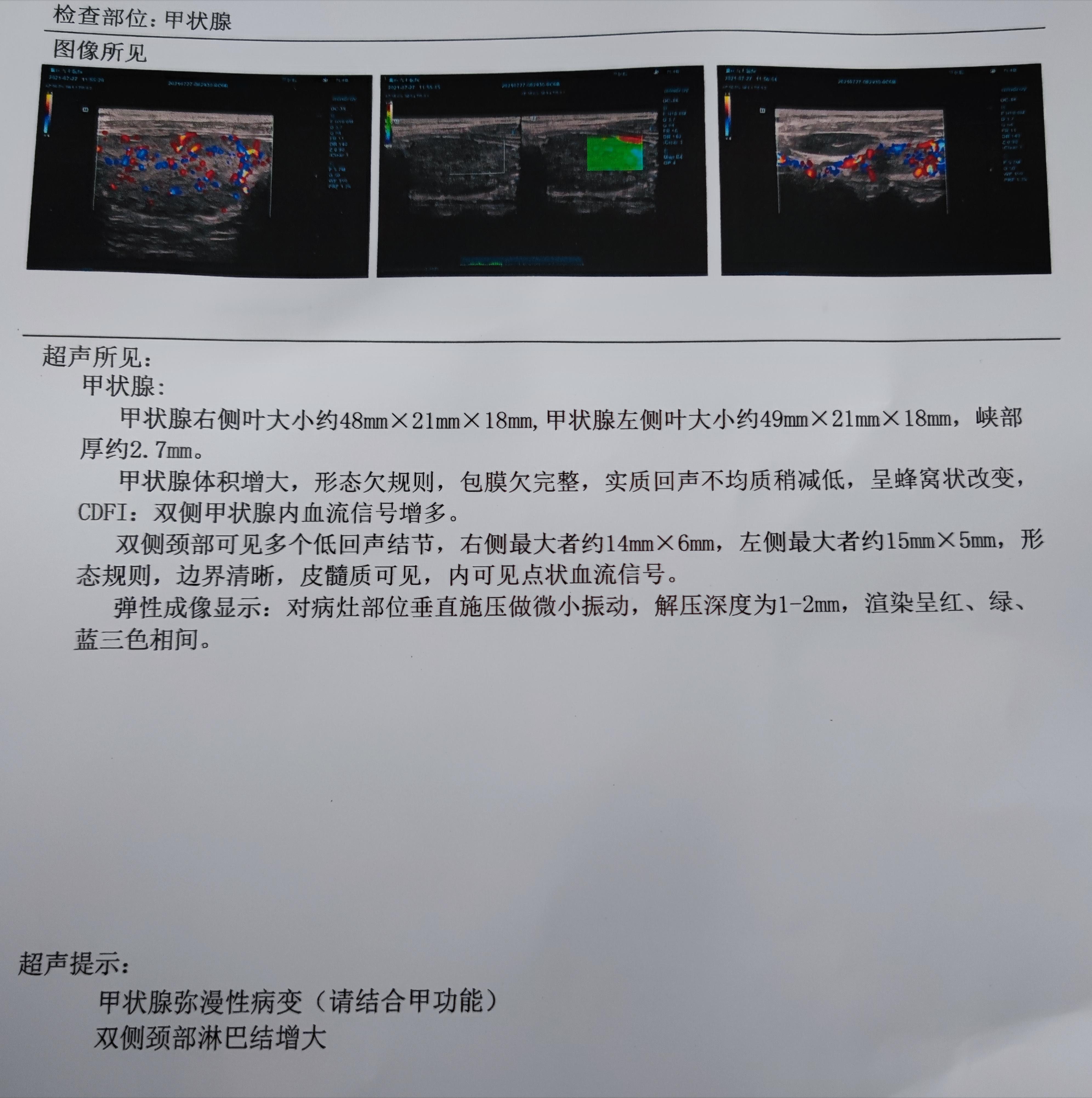 甲功的抗体超过1000是什么意思,甲功抗体高2000怎么办