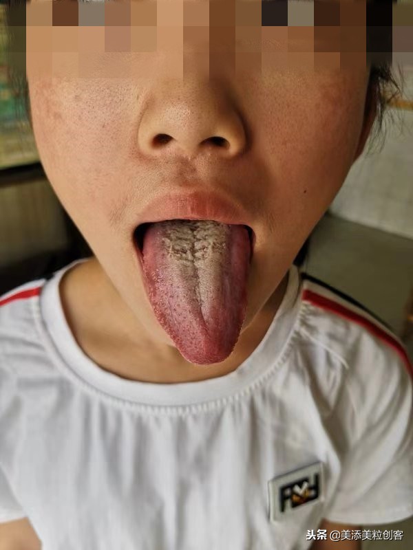 肠胃湿热症导致的闭口开口粉刺痘,这样对症而治少走很多弯路!