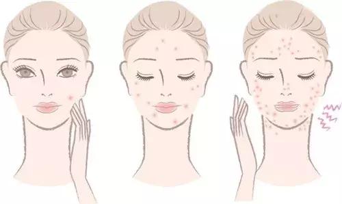 痘肌调理真实案例,痘肌10年了怎么修复