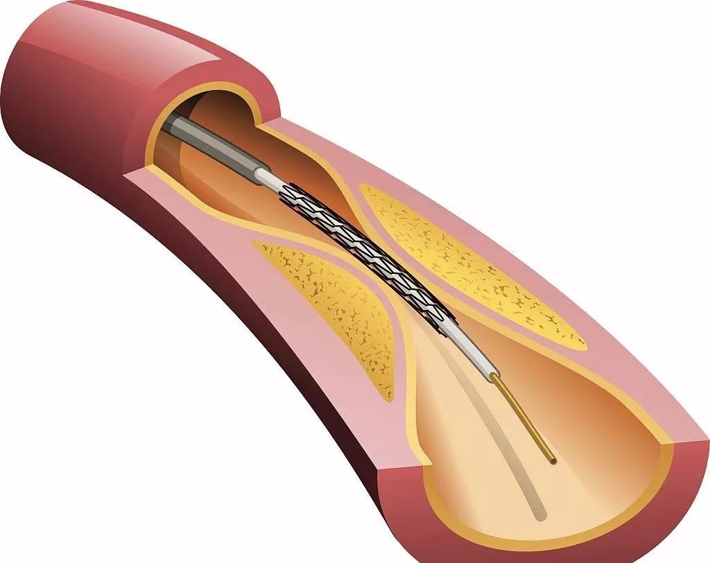 如何辨别真假心肌缺血,心肌缺血的亲身经历