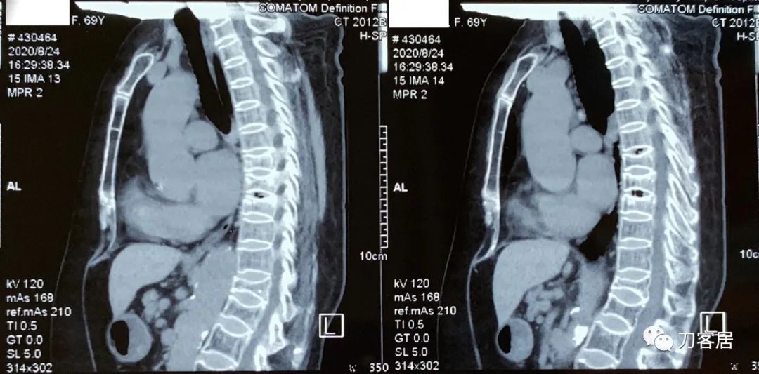 胸椎压缩性骨折病历,脊柱骨质疏松性压缩性骨折