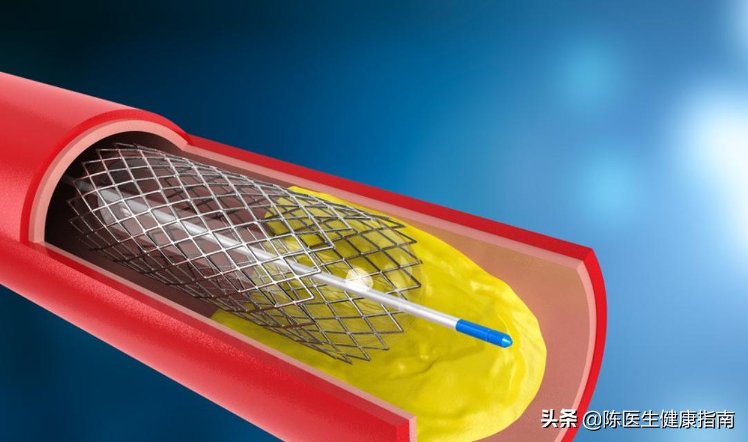 心脏支架是怎么把血管撑开的,心脏支架手术血管撕裂怎么办