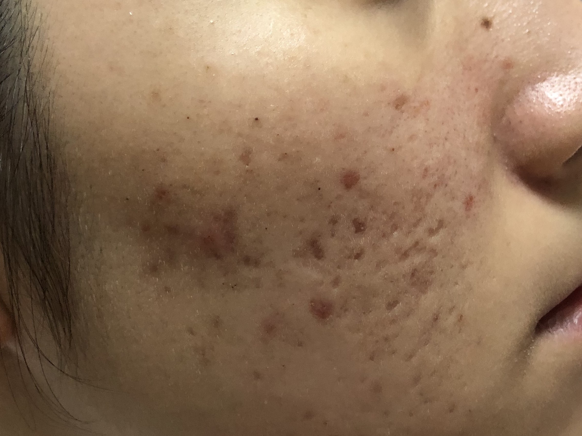 17岁女儿脸上长满痘痘，看了这篇文章才知道如何帮助她