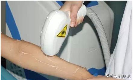 激光脱毛能永久吗脸上,激光脱毛能永久吗知乎