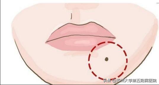 色素痣病理报告,头上色素痣图片