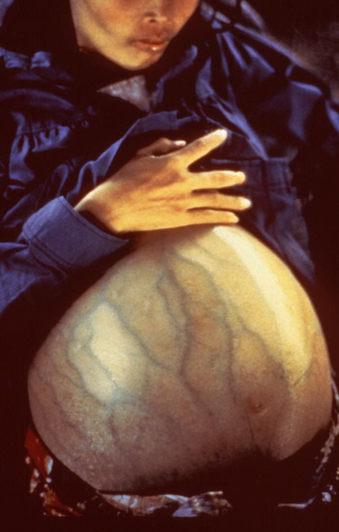 白破、百白破、百白破-Hib、百白破-Hib-IPV——疑问解答