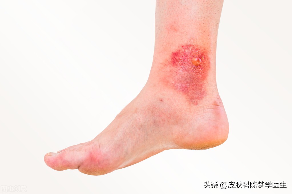 红色斑块脱屑一定是牛皮癣吗,皮肤上有癣起皮颜色呈褐色